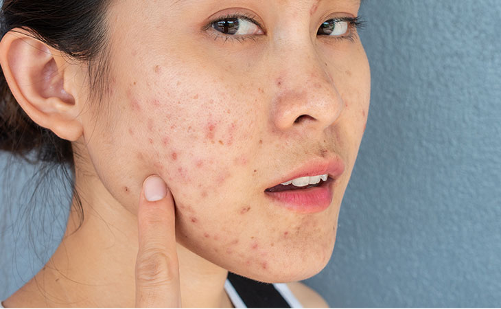 Effective Acne Skin Care Products